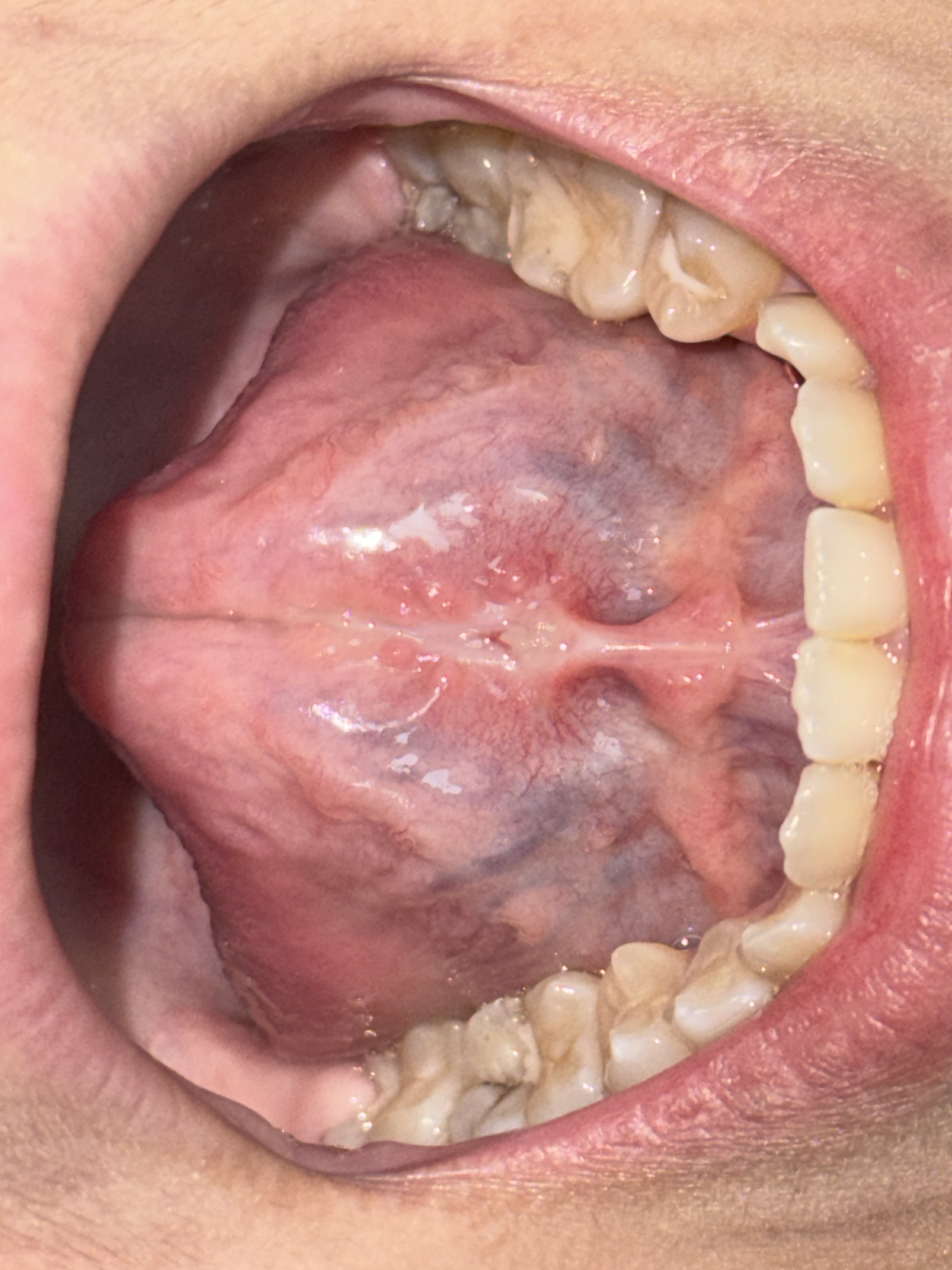 Frenectomía con láser